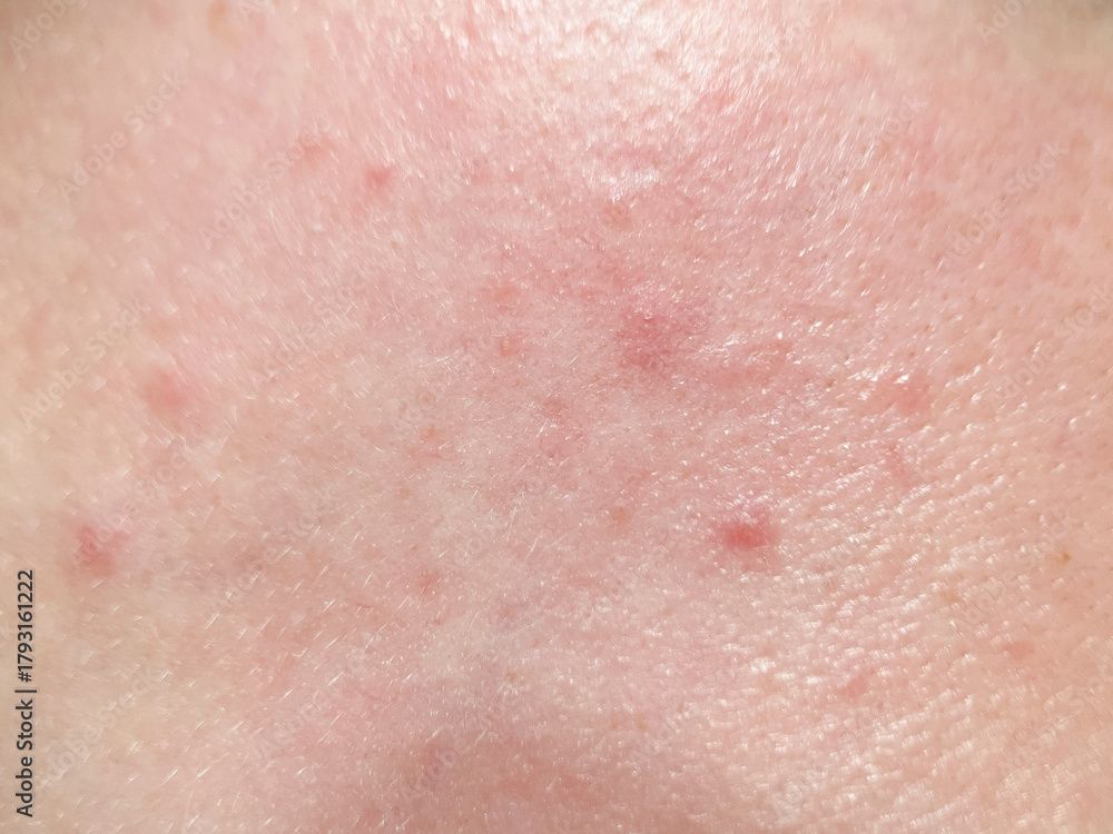 Fototapeta premium Close up of irritated human skin showing redness, bumps, and inflammation. Ideal for dermatology, skincare issues, allergy symptoms, medical illustration, and health education materials.