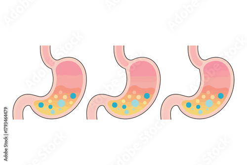 Illustration of three human stomachs showing digestion processes and stomach fluids.