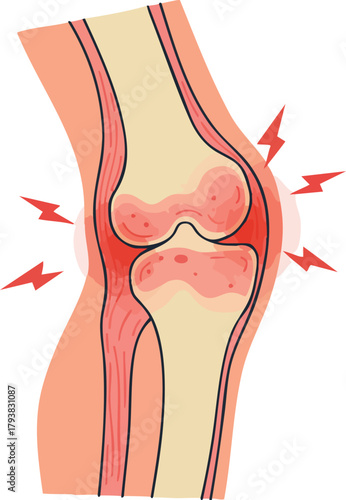 Illustration of a knee joint with arthritis, showing inflammation and pain, depicted in a medical style with bold lines and vibrant red colors.