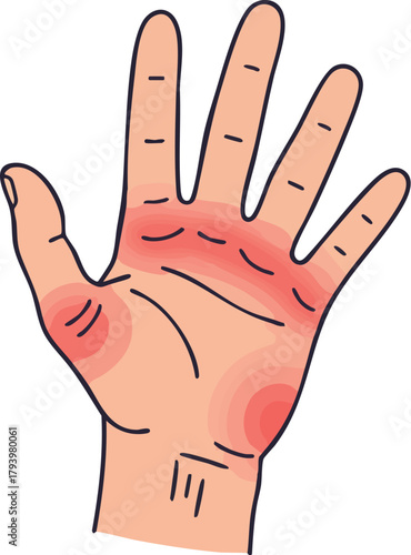 An illustrated hand with red, inflamed areas indicating arthritis pain on a plain white background.