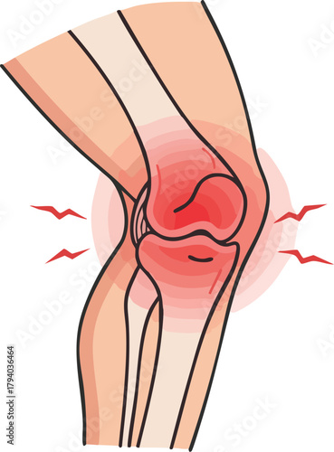 Illustration of a human knee with highlighted red inflammation indicating arthritis pain on a white background.