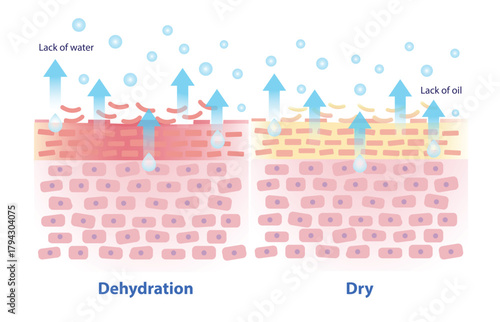 The mechanism of dehydration and dry skin vector illustration on white background. Comparison of dehydrated skin lacks water, feel dull, rough, tight and dry skin lacks oil, feel flaky, itchy. 