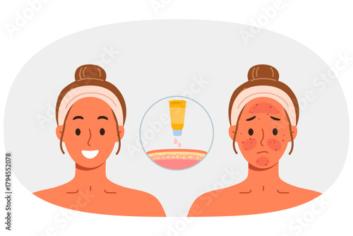 Sunscreen that protects skin from burns and solar radiation, next to girls demonstrating results before and after. Sunscreen for solarium visitors or tourists vacationing in tropical countries