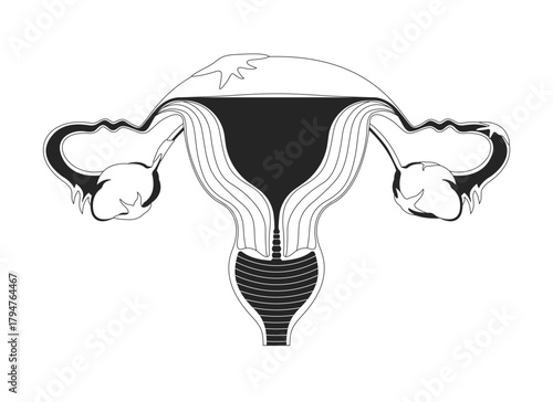 Female reproductive system with endometriosis lesions outline illustration. Ovary inflammation. Chronic illness. Fallopian damage 2D line object isolated on white. Monochrome vector ink linear image