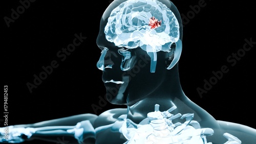 Tableau sur toile 3d rendered of cancerous tumor growing inside the human brain, brain tumor and b
