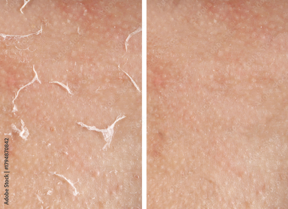 Fototapeta premium Dry skin before and after moisturizing, marco view. Collage for comparison
