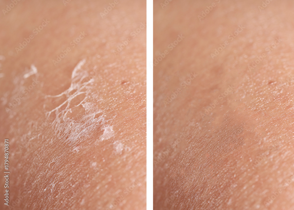 Fototapeta premium Dry skin before and after moisturizing, marco view. Collage for comparison