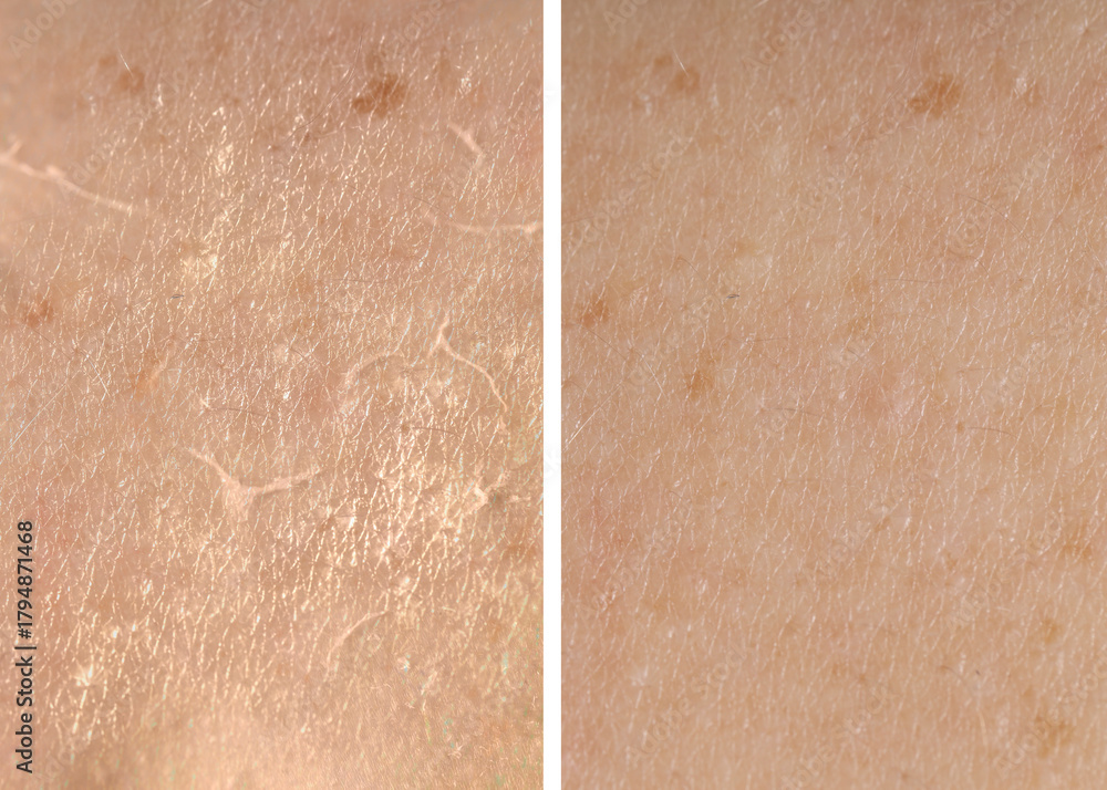 Fototapeta premium Dry skin before and after moisturizing, marco view. Collage for comparison