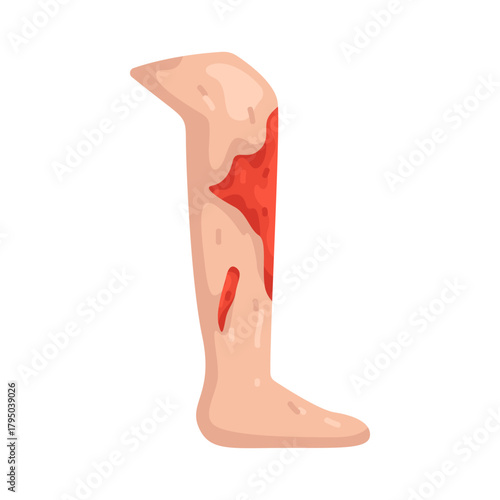  Illustration of Leg Wound