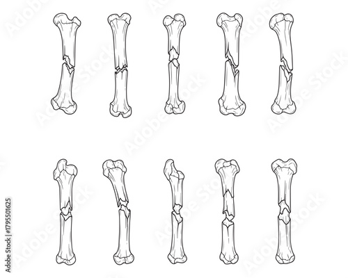 Bone fractures illustration medical skeletal damage black and white