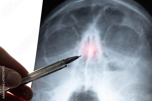 Doctor learning medical X-ray of head Injury. Deviated Nasal Septum. Nose trauma.