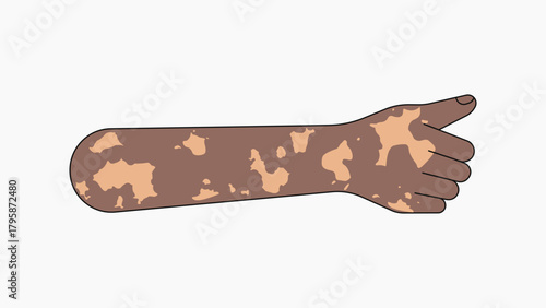 Vitiligo thumbs up hand, gesture collage element vector