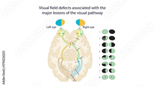 Visual field defects
isual field defects refer to loss of vision in specific areas of the visual field caused by damage anywhere along the visual pathway, from the retina to the occipital cortex. The 