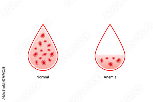 Anemia Disease Science Design. Vector Illustration.