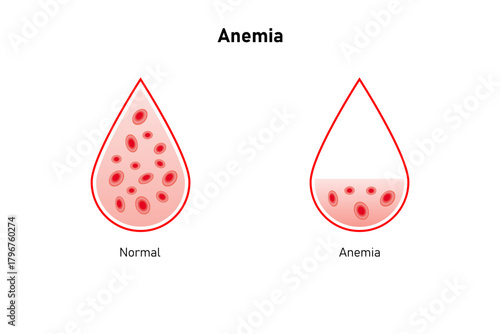 Anemia Disease Science Design. Vector Illustration.