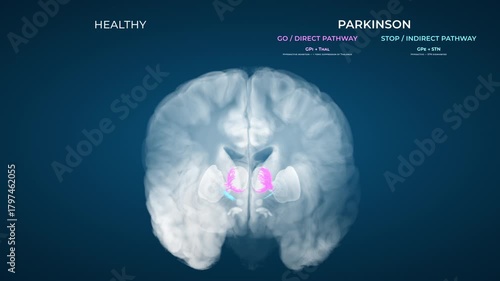 Healthy vs Parkinsons Basal Ganglia Motor Circuits Coronal View
