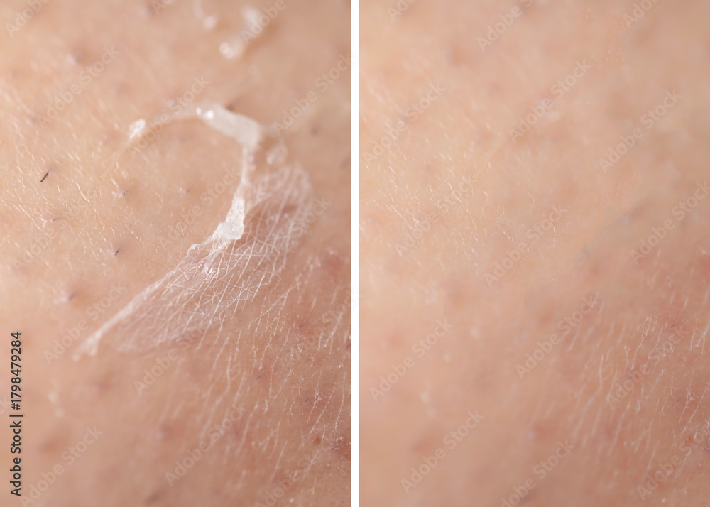 Fototapeta premium Dry skin before and after moisturizing, marco view. Collage for comparison