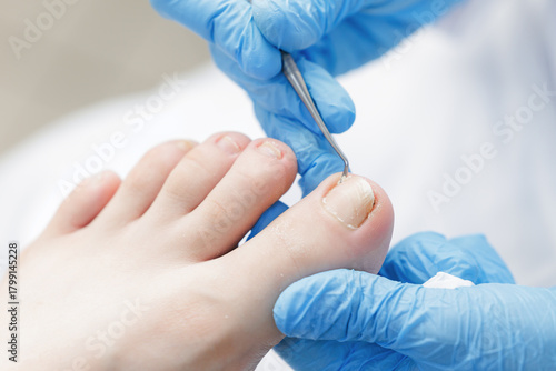 closeup of podiatrist treating toenails with gloves and tools