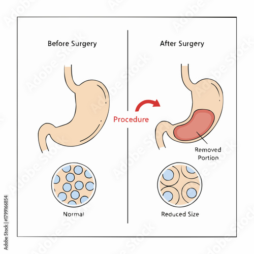 Gastric Sleeve Surgery Reducing Stomach Size for Weight Management