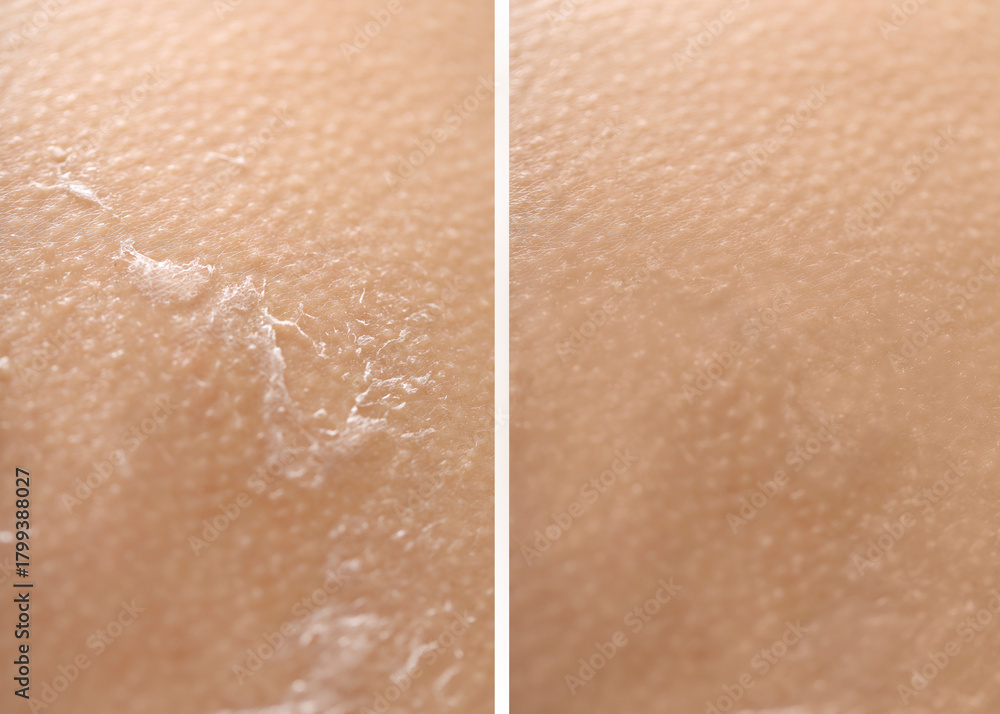 Fototapeta premium Dry skin before and after moisturizing, marco view. Collage for comparison