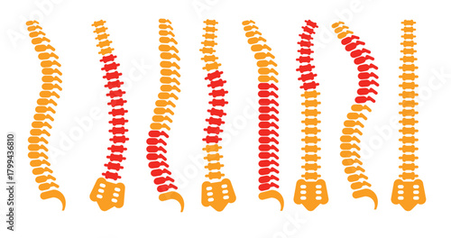 comparing different human spine shapes with correct and 