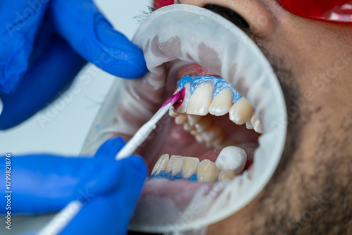 dentist applies whitening gel on the teeth whitening procedure