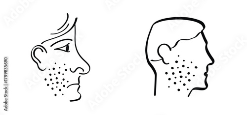 Skin rash, measles on face. Red rash on the body. A sign of measles, lupus, herpes, or rubelaa, and other autoimmune diseases. Rubeola or morbilli symptom. food allergy. Red spots on body