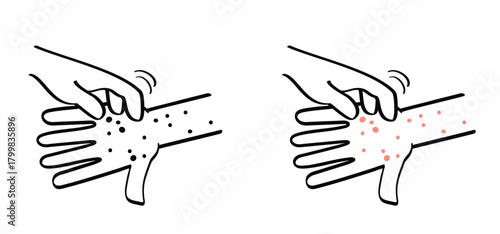 Skin rash, measles on hand. allergy causing itching, skin irritation. Red rash on the body. food allergy orother autoimmune diseases. Rubeola or morbilli symptom. food allergy. Eczema, smallpox.