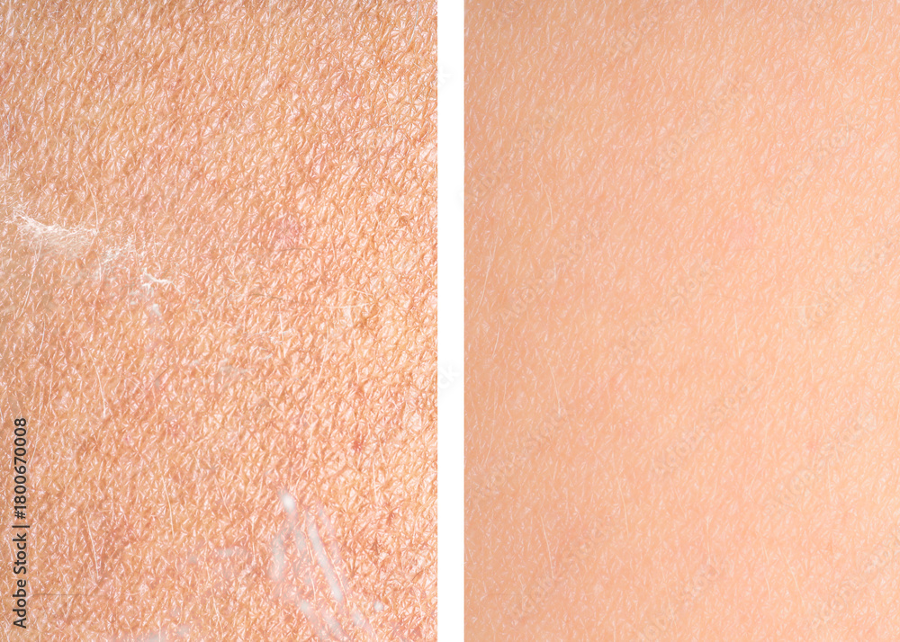 Fototapeta premium Dry skin before and after moisturizing, marco view. Collage for comparison