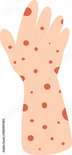 Human hand and arm covered in red skin rash spots. Allergic reaction, infection, or disease symptom. Flat vector illustration.