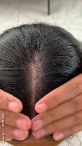 dandruff on woman scalp with long black hair.
