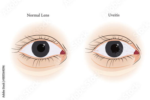 Medical illustration comparing a normal eye to uveitis inflammation with visible iris changes. eps 10