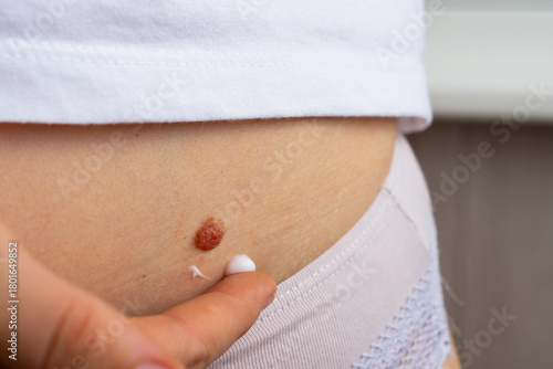 Birthmark on skin highlighting sun protection