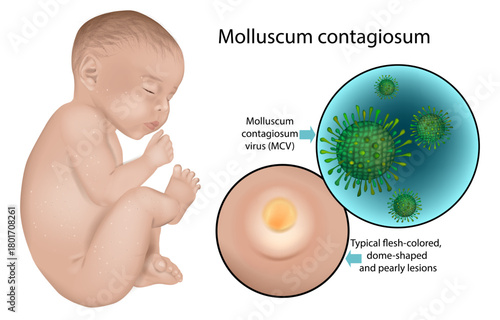 Medical Diagram of Molluscum Contagiosum Virus and Skin Lesions. Infant Skin Infection Visualization with Molluscum Contagiosum Virus