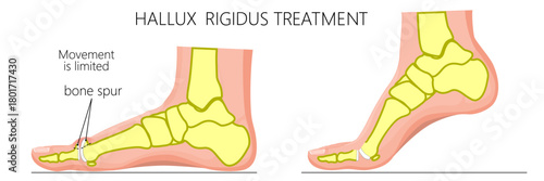Hallux rigidus treatment. Cheilectomy