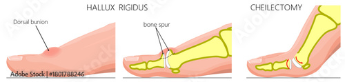 Hallux rigidus cheilectomy. Close up view