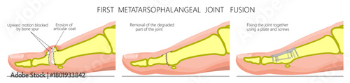Hallux rigidus traetment. Joint fusion using a plate and screws