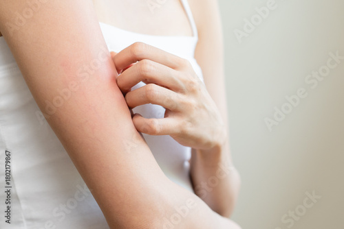 Wallpaper Mural Dermatology, asian young woman reaction from atopic, insect bites on her arm, hand in scratching itchy red spot or rash of skin. Healthcare, treatment of beauty. Torontodigital.ca