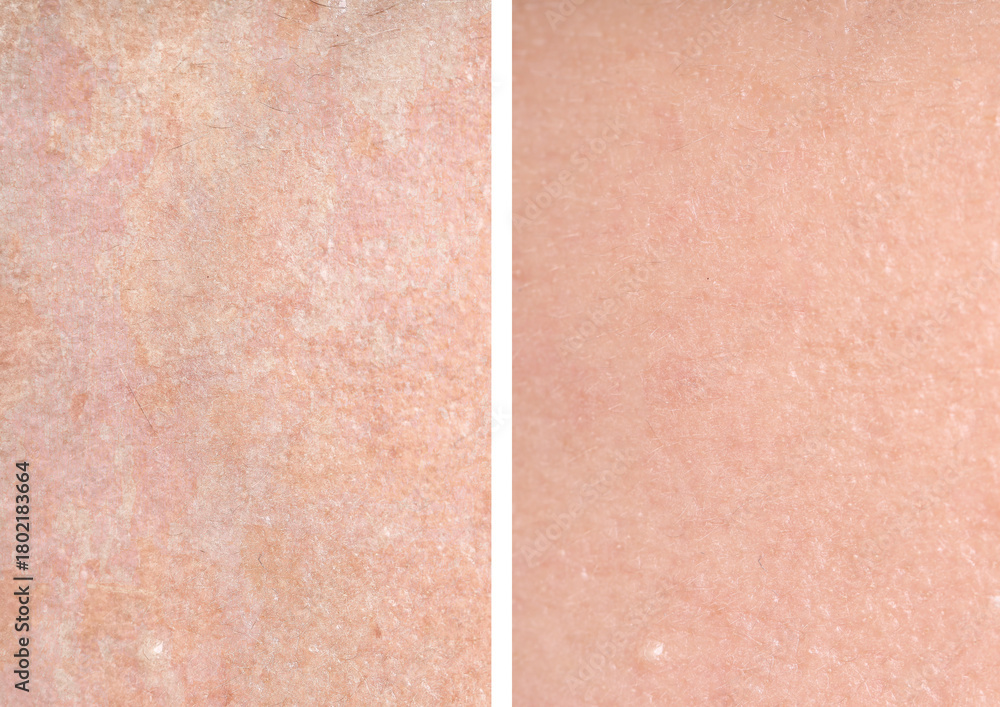 Fototapeta premium Dry skin before and after moisturizing, marco view. Collage for comparison