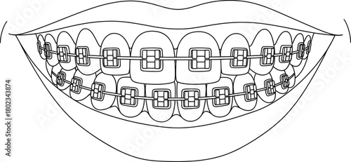 Detailed vector line illustration of a mouth and lips showing teeth with full orthodontic metal braces, symbolizing dentistry, alignment correction, and specialized orthodontic treatment.