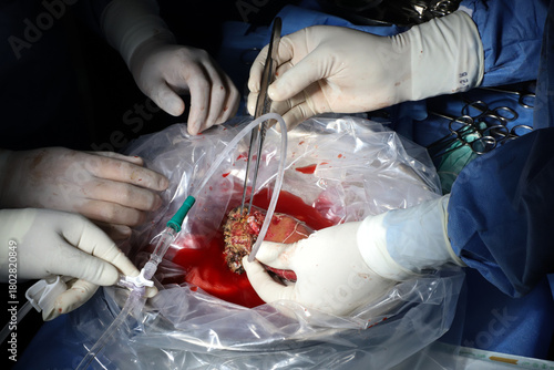 Foto Surgical Team Adjusting Instruments During Liver Transplant Operation