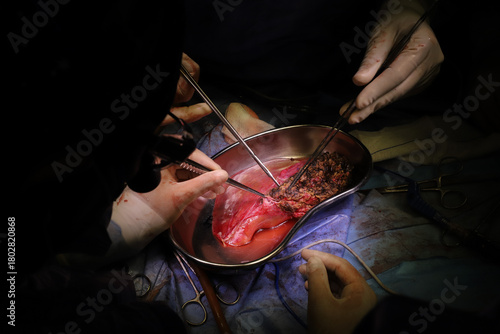 Tapet Hepatic Graft Preparation During Liver Transplant Surgery