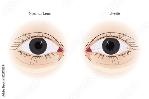 Detailed diagram showing normal eye structure versus uveitis-related ocular inflammation