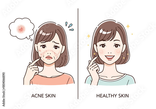 Illustration of comparison of acne skin and healthy skin, showing a woman with blemishes and pimples on one side and clear, radiant skin on the other