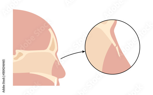 Nasal fracture poster