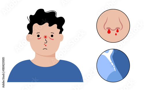Nasal fracture poster