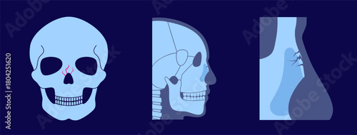 Nasal fracture poster