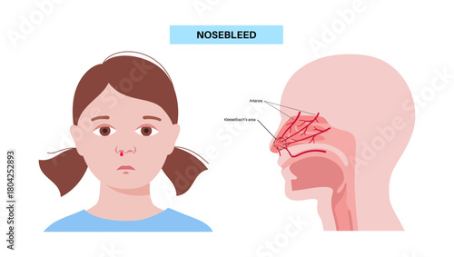 Nosebleed medical poster
