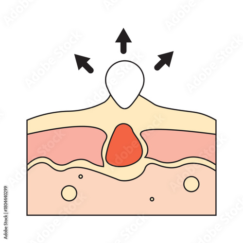 Pimple Removal Illustration