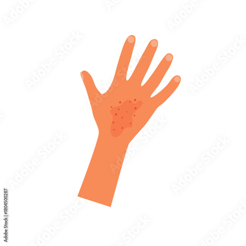Rash on hand and arm skin, isolated medical icon
